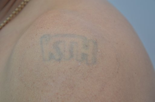Лазерное удаление татуировок в центре лазерной косметологии «Медлайн» в Харькове. Обращайтесь по акции.