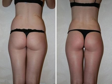 Anti-cellulite massage of the buttocks in the studio «Lazarev Wellness» in Kharkov. Sign up for the promotion.