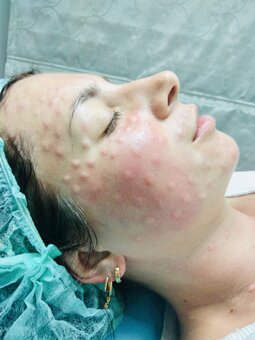 Мезотерапия лица в студии косметологии «LaEsthetics» в Киеве. Записаться на процедуры со скидкой.