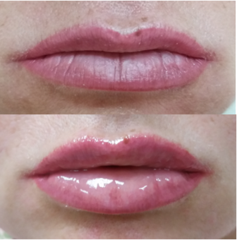 Lip augmentation in the cosmetology studio of Lyudmila Grushko. Sign up for a discount