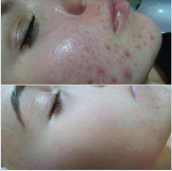 Acne treatment in the cosmetology studio of Lyudmila Grushko. Sign up for a discount