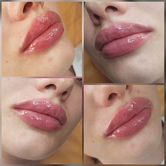 Косметолог Олена Кузьменко в києві. пластика губ недорого.