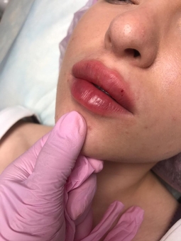 Косметолог Олена Кузьменко в Києві. контурна пластика губ, знижки.